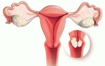 Признаки и симптомы рака шейки матки на ранней и поздней стадиях