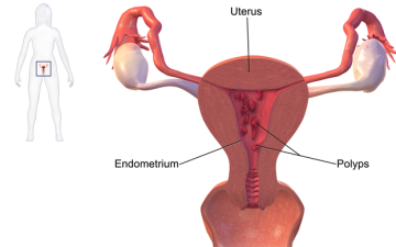 Что такое гиперпластический процесс эндометрия