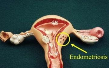 Эндометриоз матки — что это такое доступным языком?