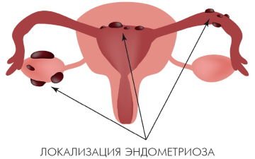 Симптомы и лечение наружного генитального эндометриоза