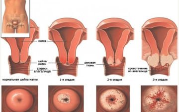 Что такое аденокарцинома матки и ее классификация
