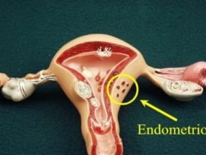 Эндометриоз матки - что это такое доступным языком?